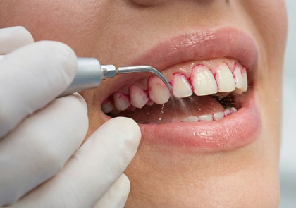 Почему профессиональная гигиена у стоматолога важна даже при тщательной чистке зубов