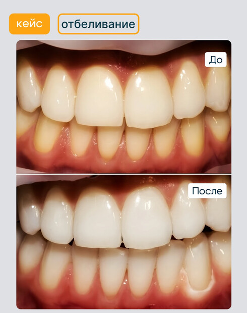 Чем отличается чистка зубов от отбеливания