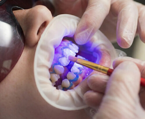 Чем отличается чистка зубов от отбеливания