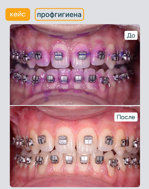 Профессиональная чистка зубов с брекетами: зачем делают, в чём отличия от обычной и зачем снимают дуги