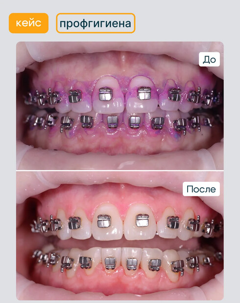 Профессиональная чистка зубов с брекетами: зачем делают, в чём отличия от обычной и зачем снимают дуги