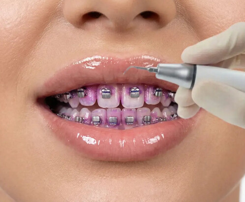 Профессиональная чистка зубов с брекетами: зачем делают, в чём отличия от обычной и зачем снимают дуги