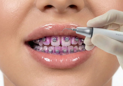 Профессиональная чистка зубов с брекетами: зачем делают, в чём отличия от обычной и зачем снимают дуги