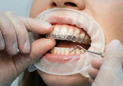 Профессиональная чистка зубов с элайнерами: уход за зубами и капами
