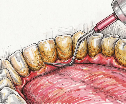 Зубной камень: почему он опасен и как его удаляют