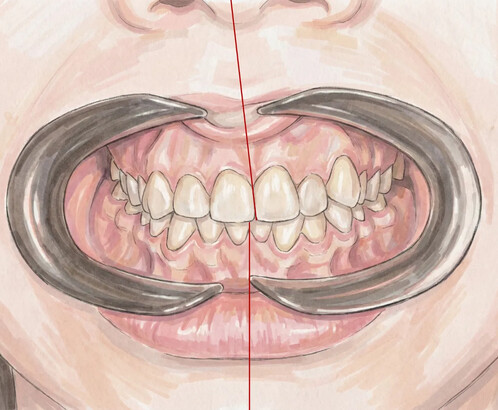 Смещение средней линии зубов: причины, типы и методы коррекции