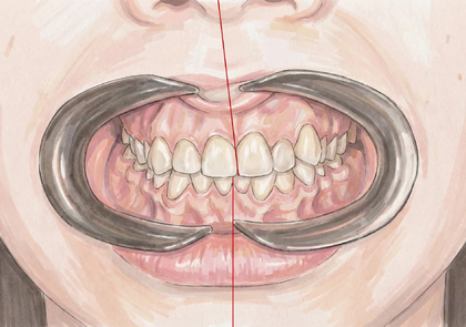 Смещение средней линии зубов: причины, типы и методы коррекции