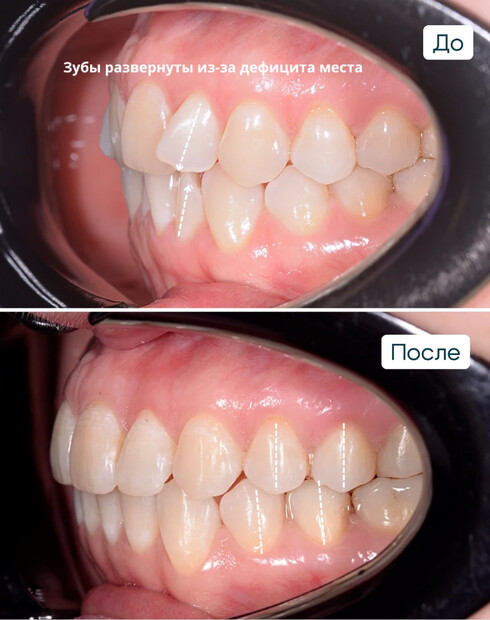 Показания и противопоказания к лечению элайнерами: когда помогут, а когда нет