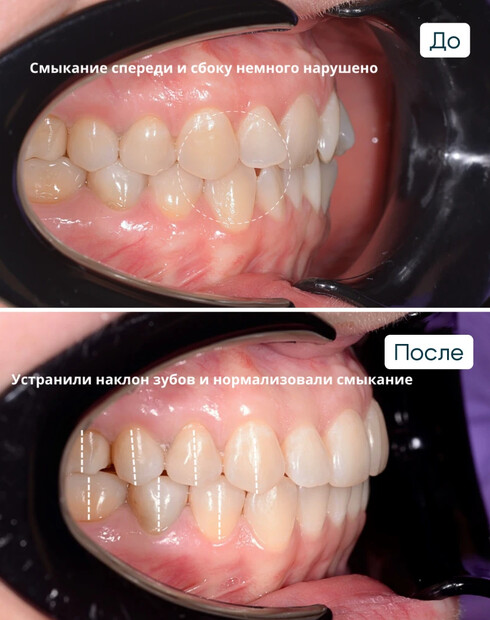 Показания и противопоказания к лечению элайнерами: когда помогут, а когда нет