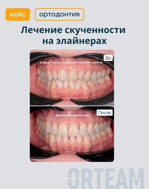 Показания и противопоказания к лечению элайнерами: когда помогут, а когда нет