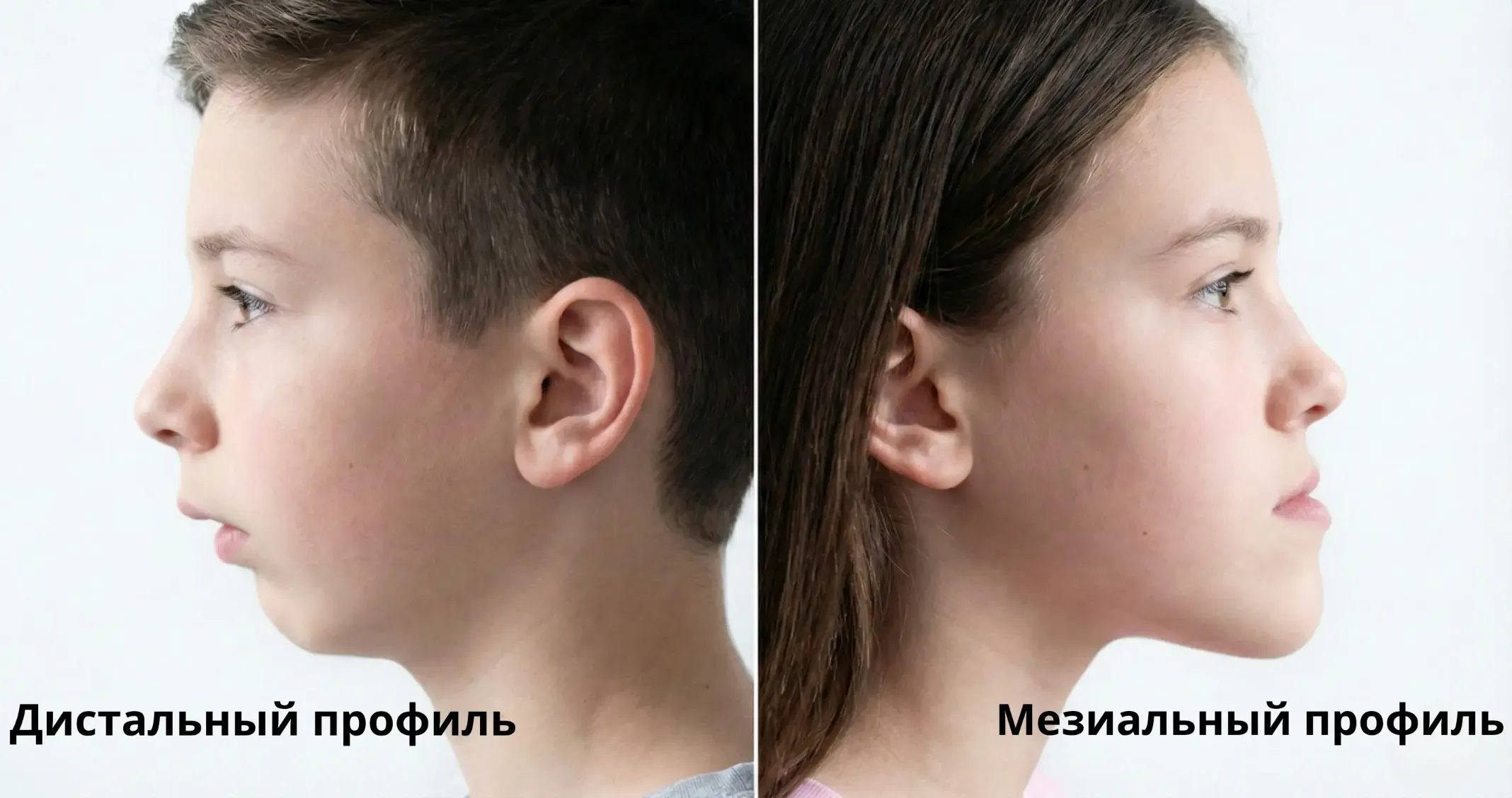 дистальный и мезиальный профиль у детей