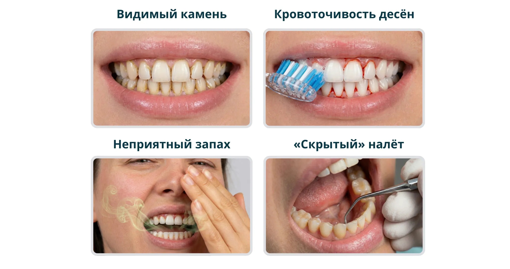 видимый камень на зубах, кровоточивость десен из-за зубного камня