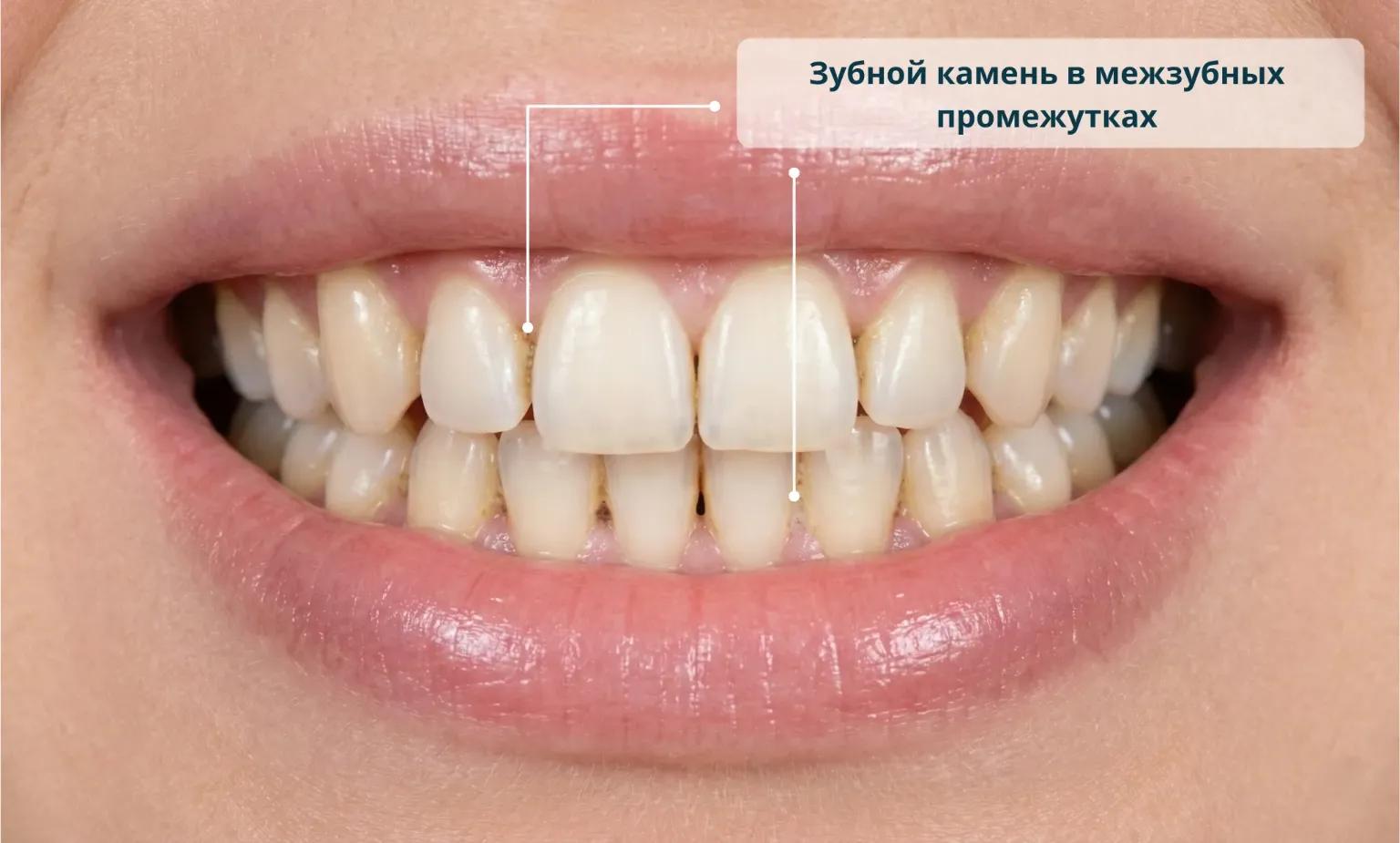 зубной камень образуется в межзубных промежутках