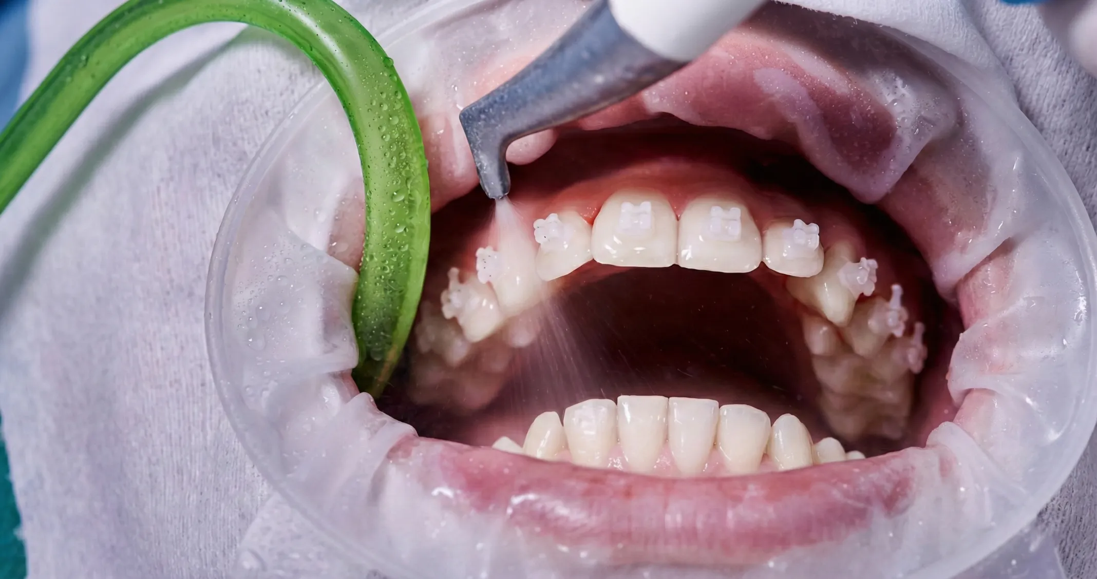 Как часто проводят проф гигиену с брекетами