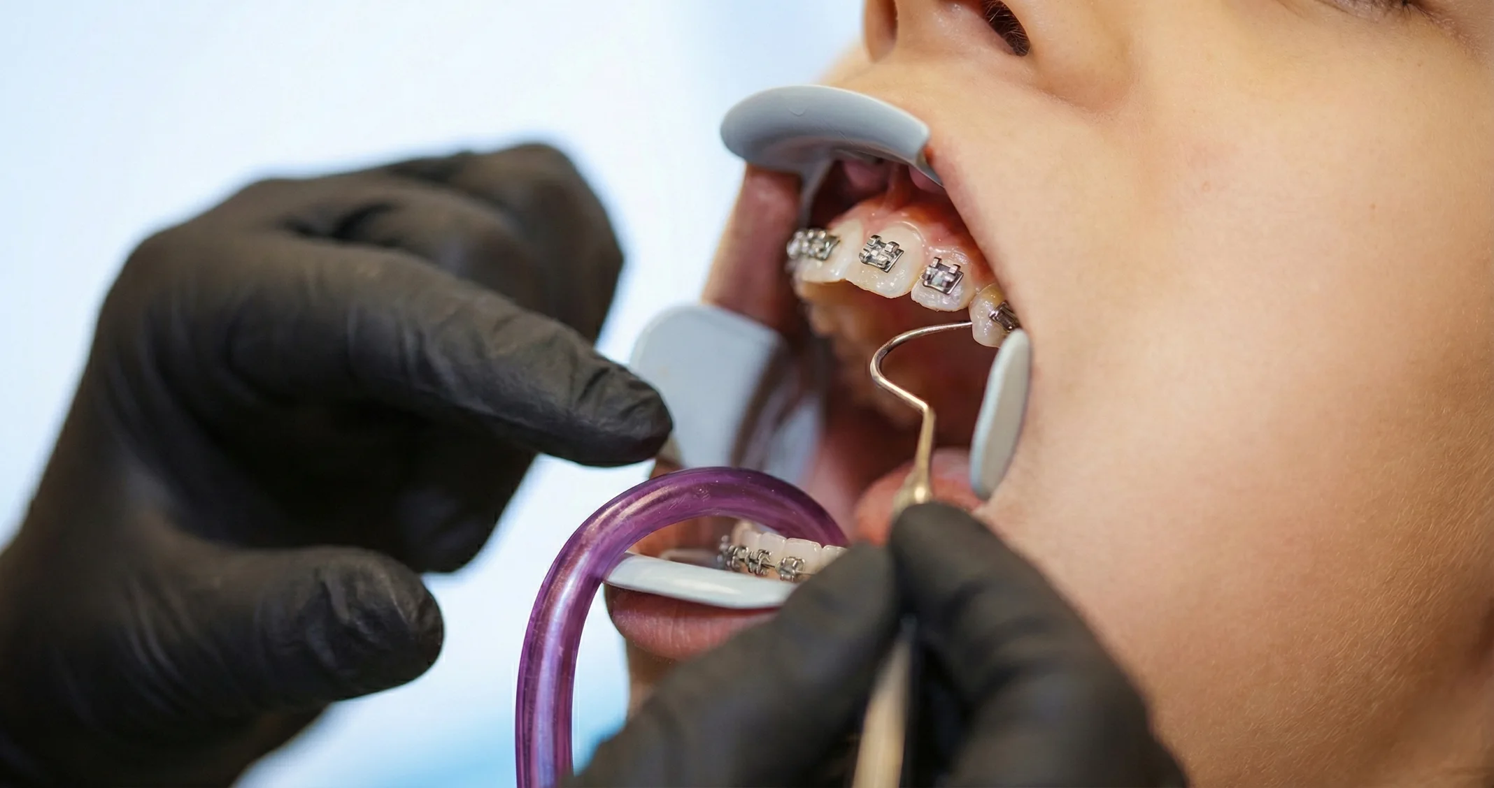 профессиональная чистка зубов с брекетами