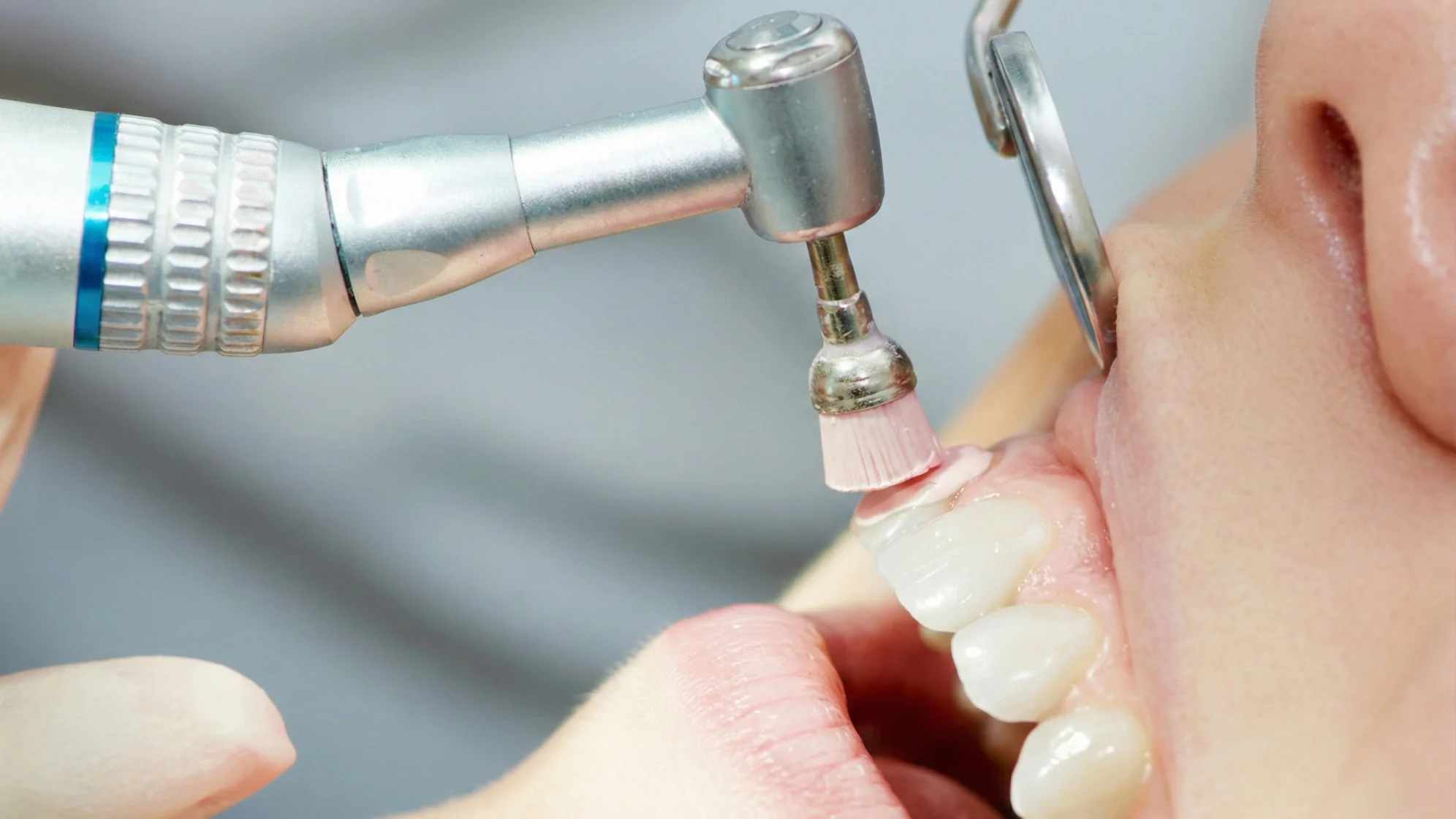 Этап 4 - механическая полировка зубов