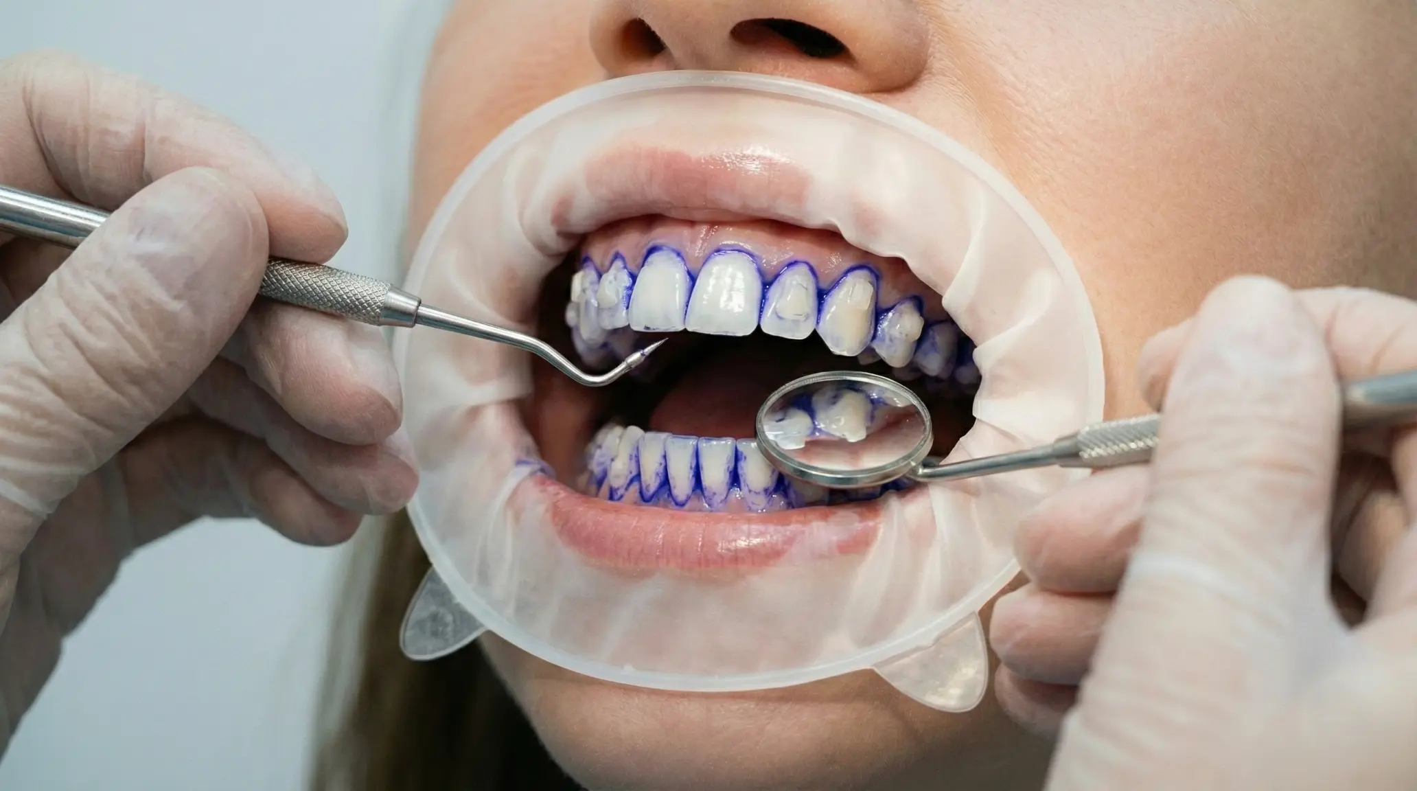 Профессиональная гигиена полости рта пациента с аттачментами на зубах