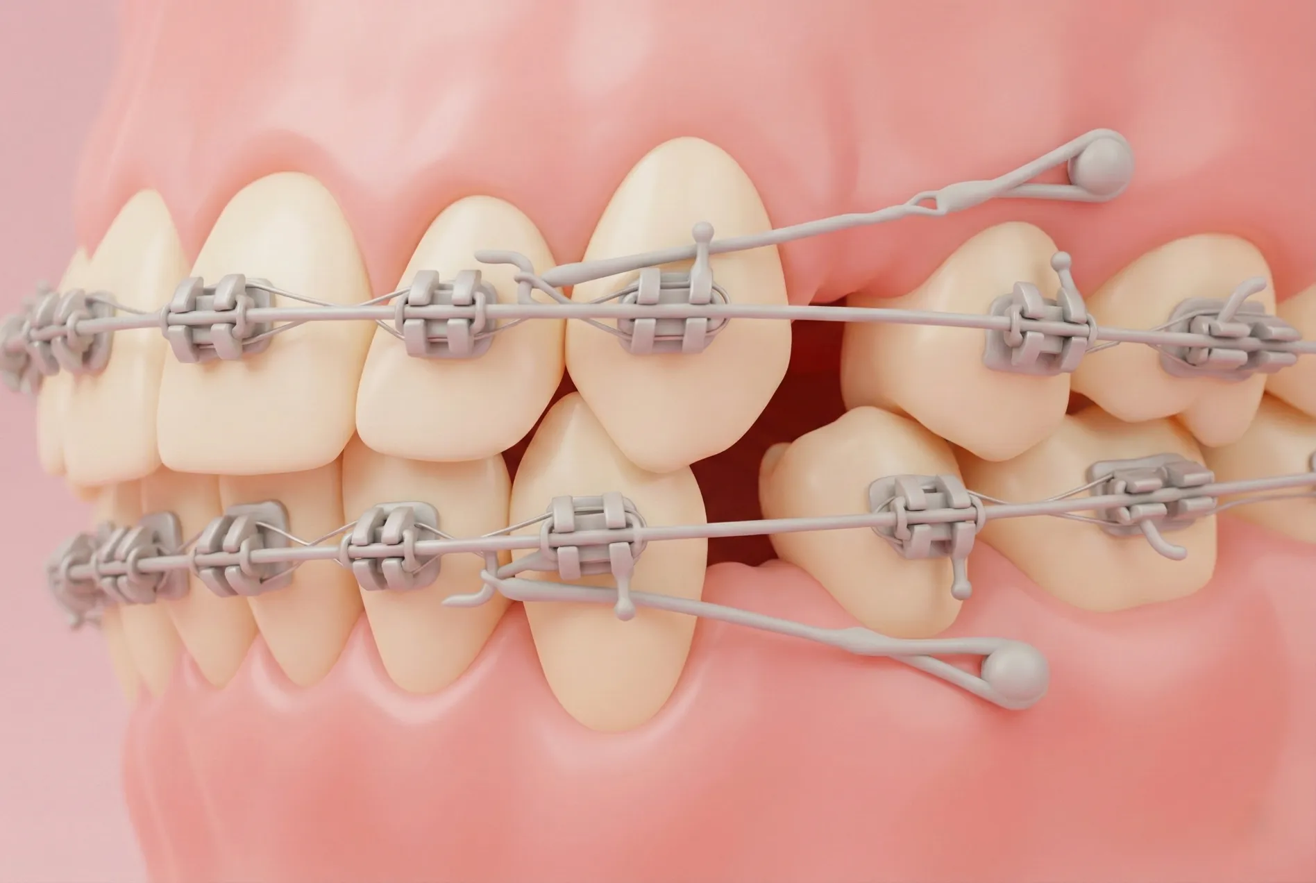 Как работают мини винты для перемещения зубов