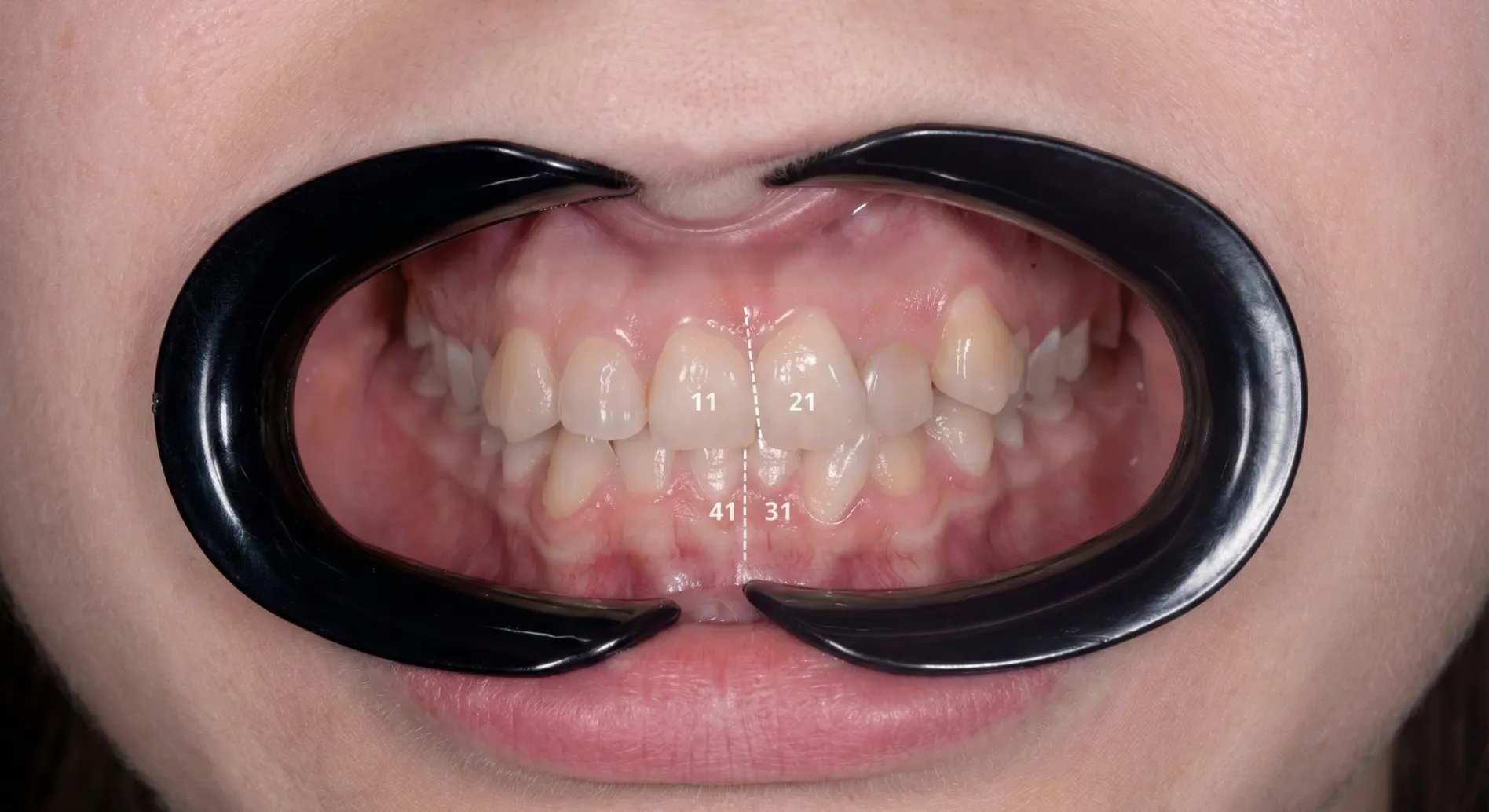 Смещение средней линии зубов и скученность