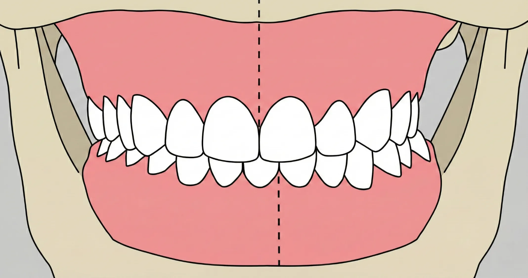 Схема смещения центральных линий зубов