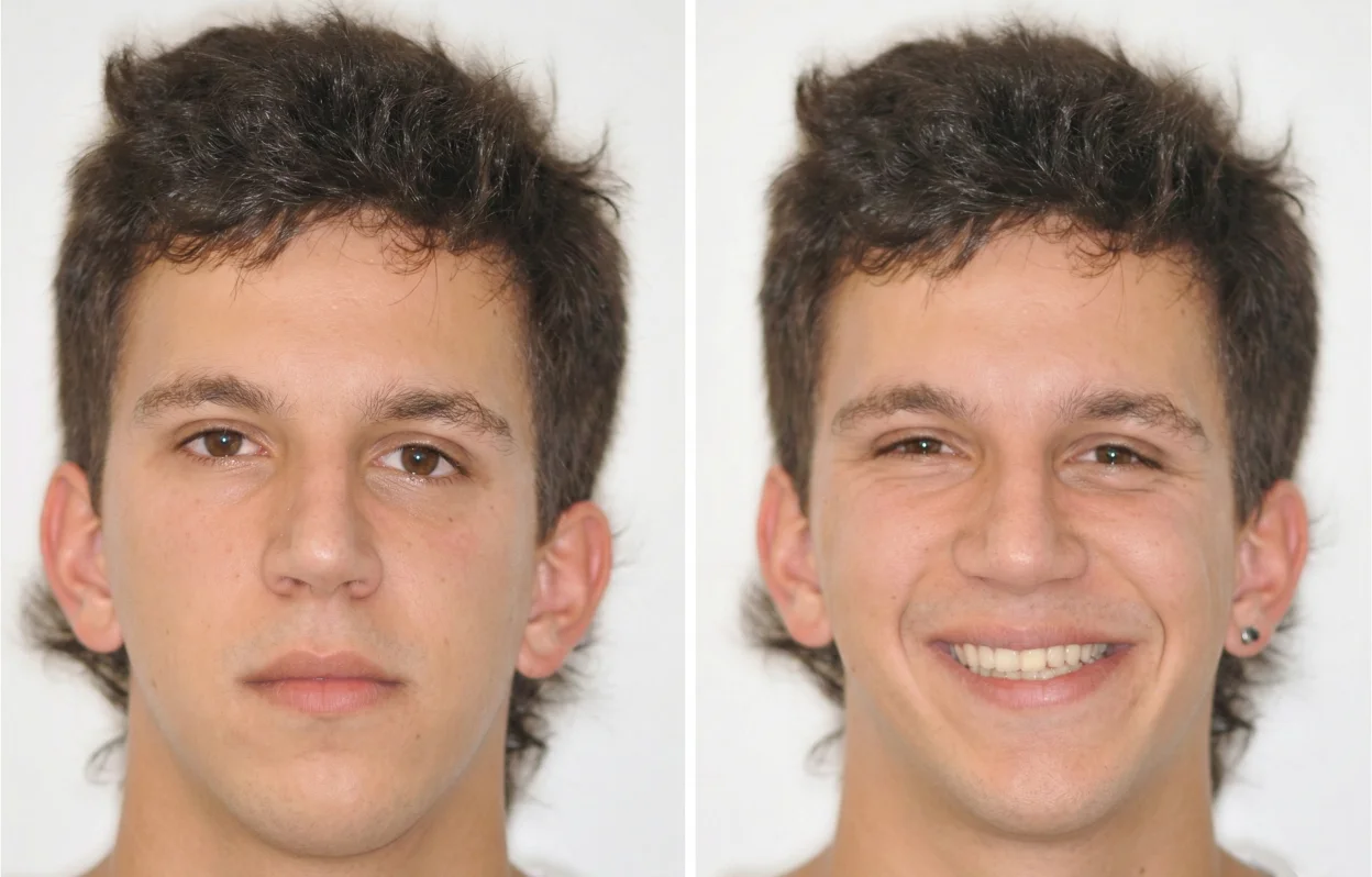 Смещение нижней части лица перекрестный прикус