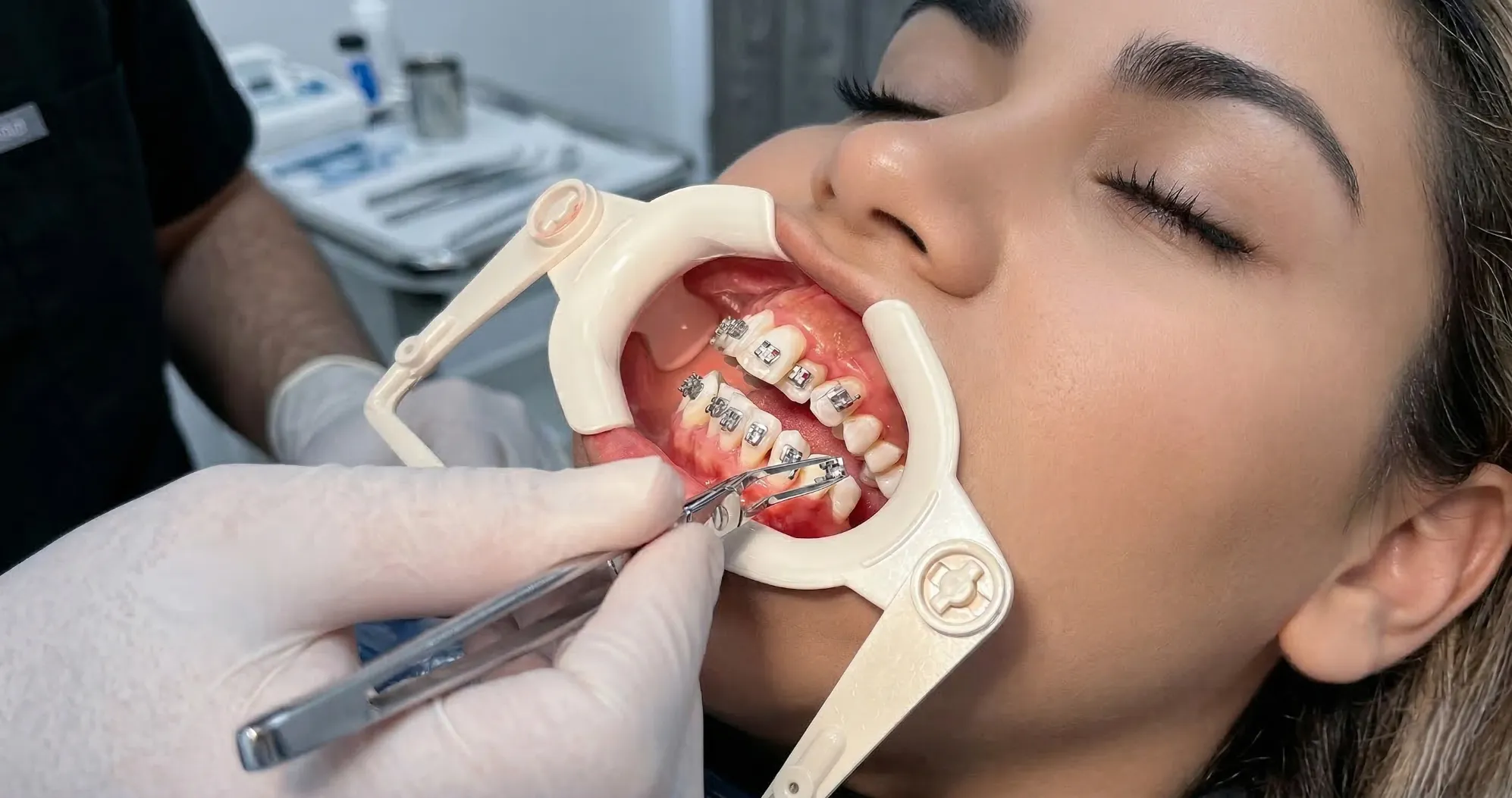 Что выбрать для выравнивания зубов брекеты или что-то другое