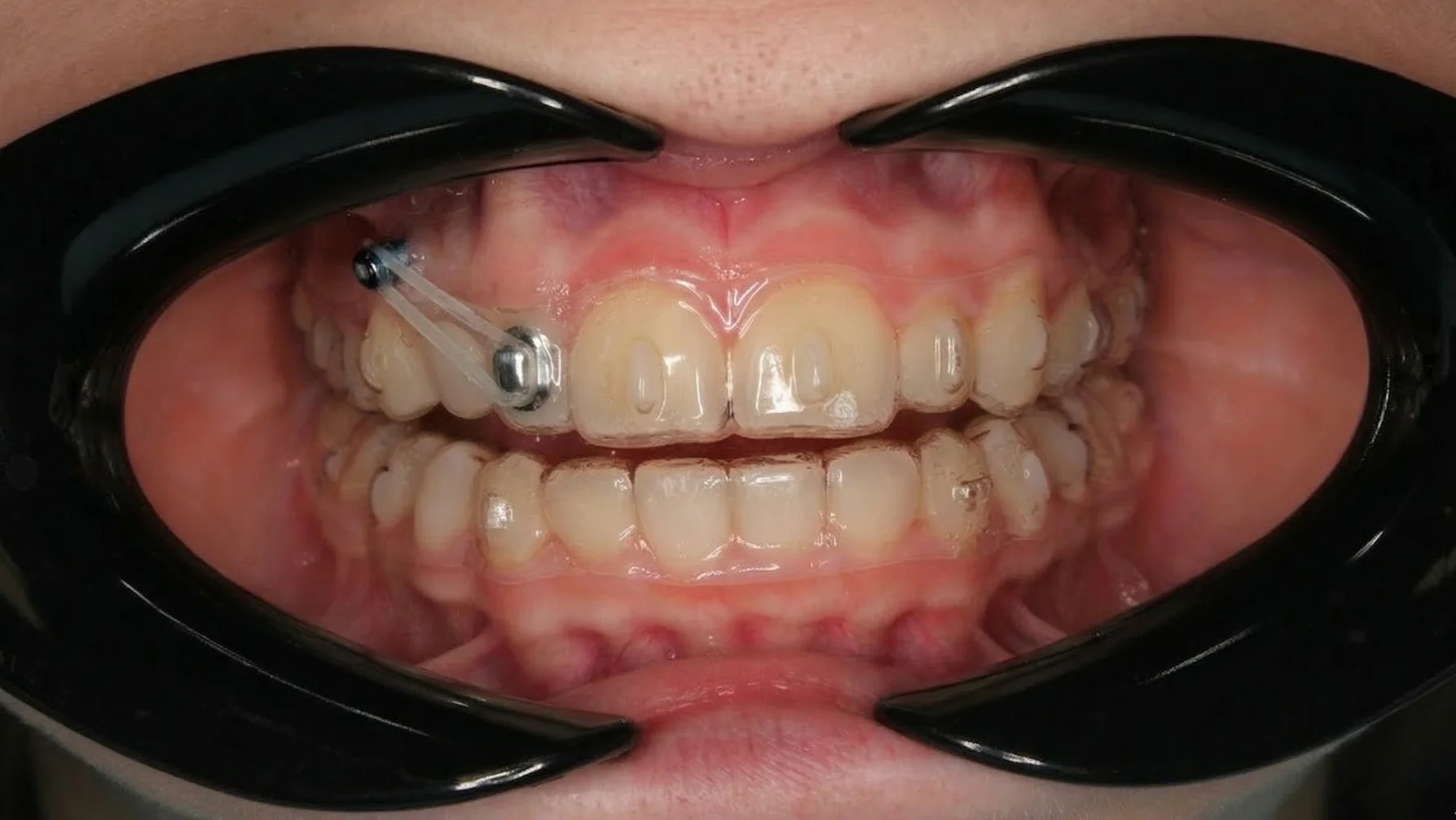 Дистализация с элайнерами и минивинтом