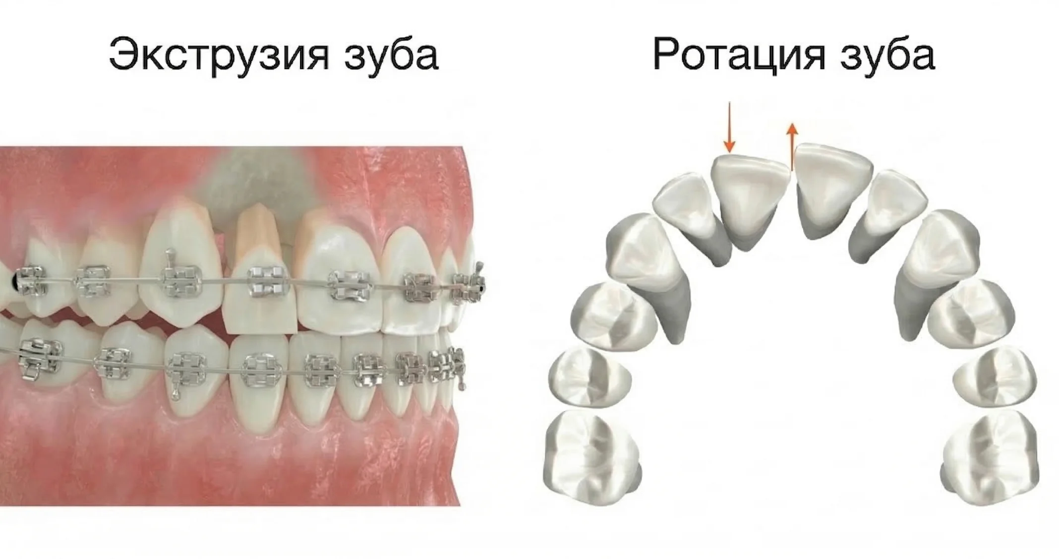 Ротация и экструзия зубов в ортодонтии