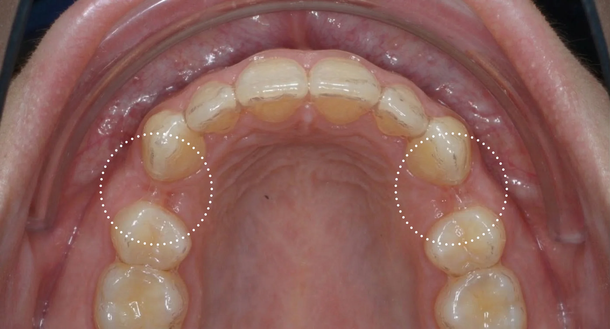 Лечение элайнерами с удалением премоляров четверок