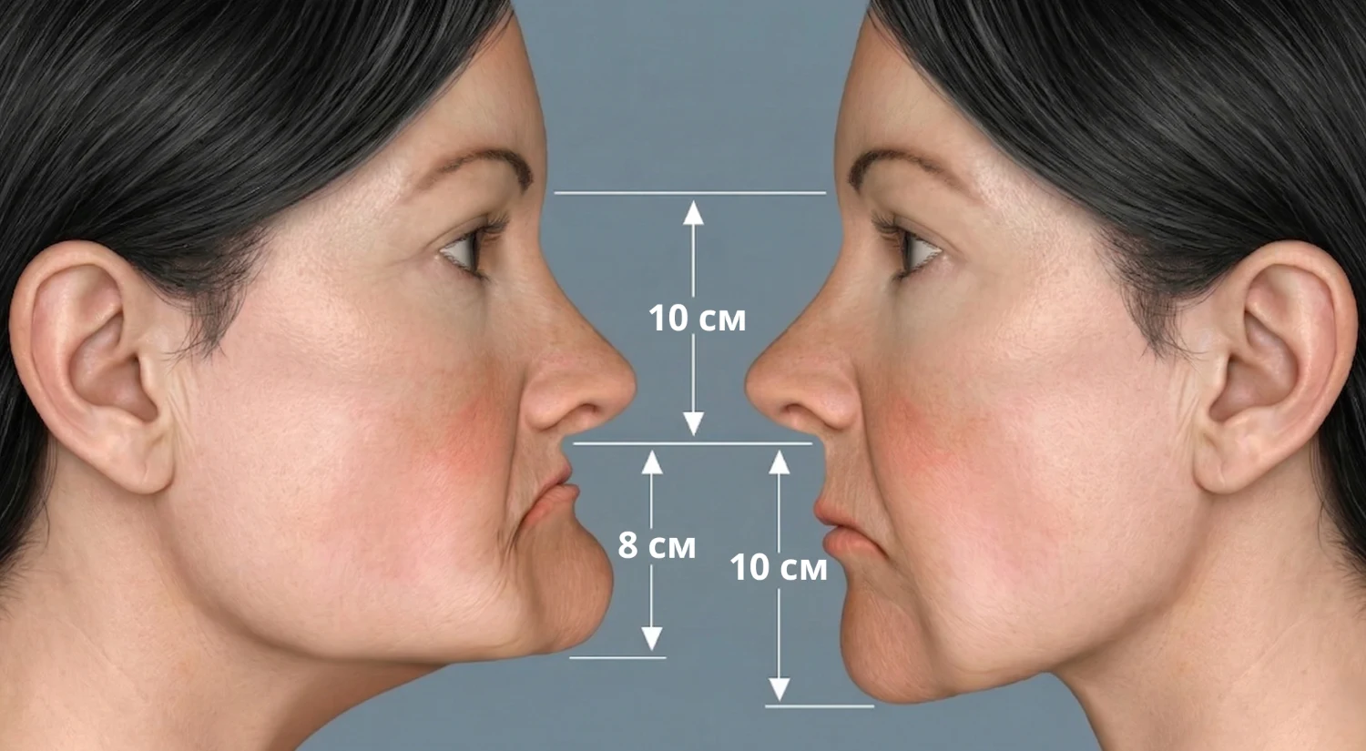 Ухудшение нижней части лица из-за отсутствия зубов и убывания кости